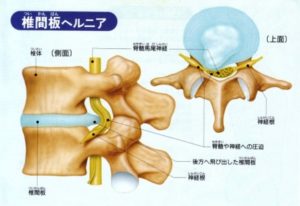 椎間板の圧迫